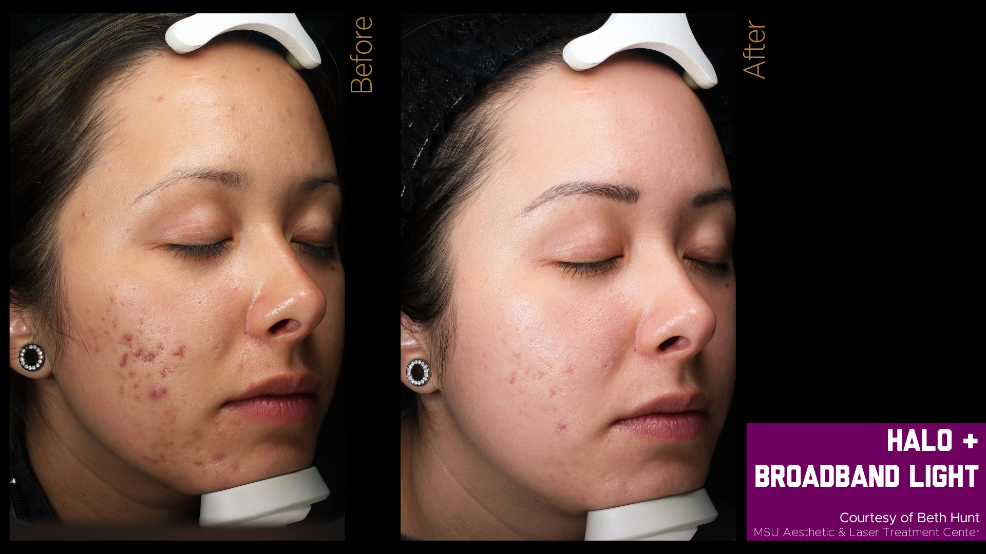 before and after of a halo treatment