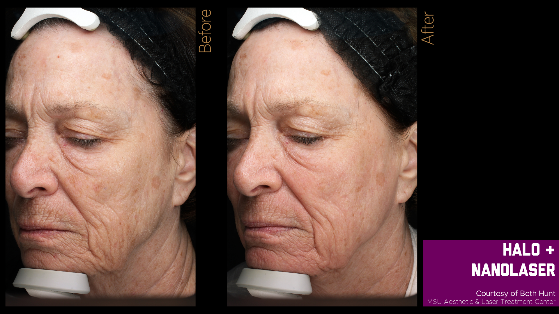 before and after halo treatment results