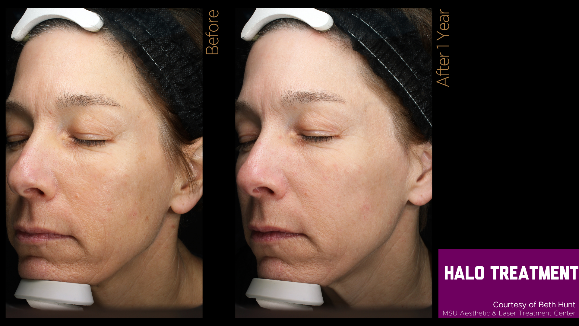 before and after halo treatment results