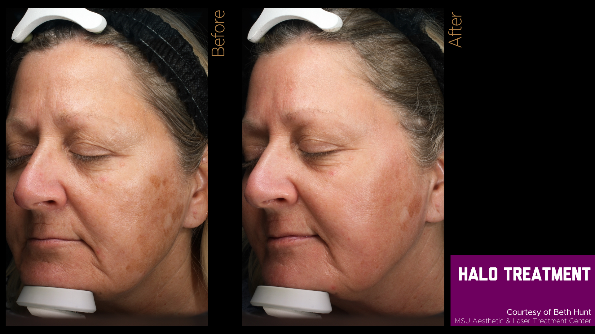 before and after halo treatment results