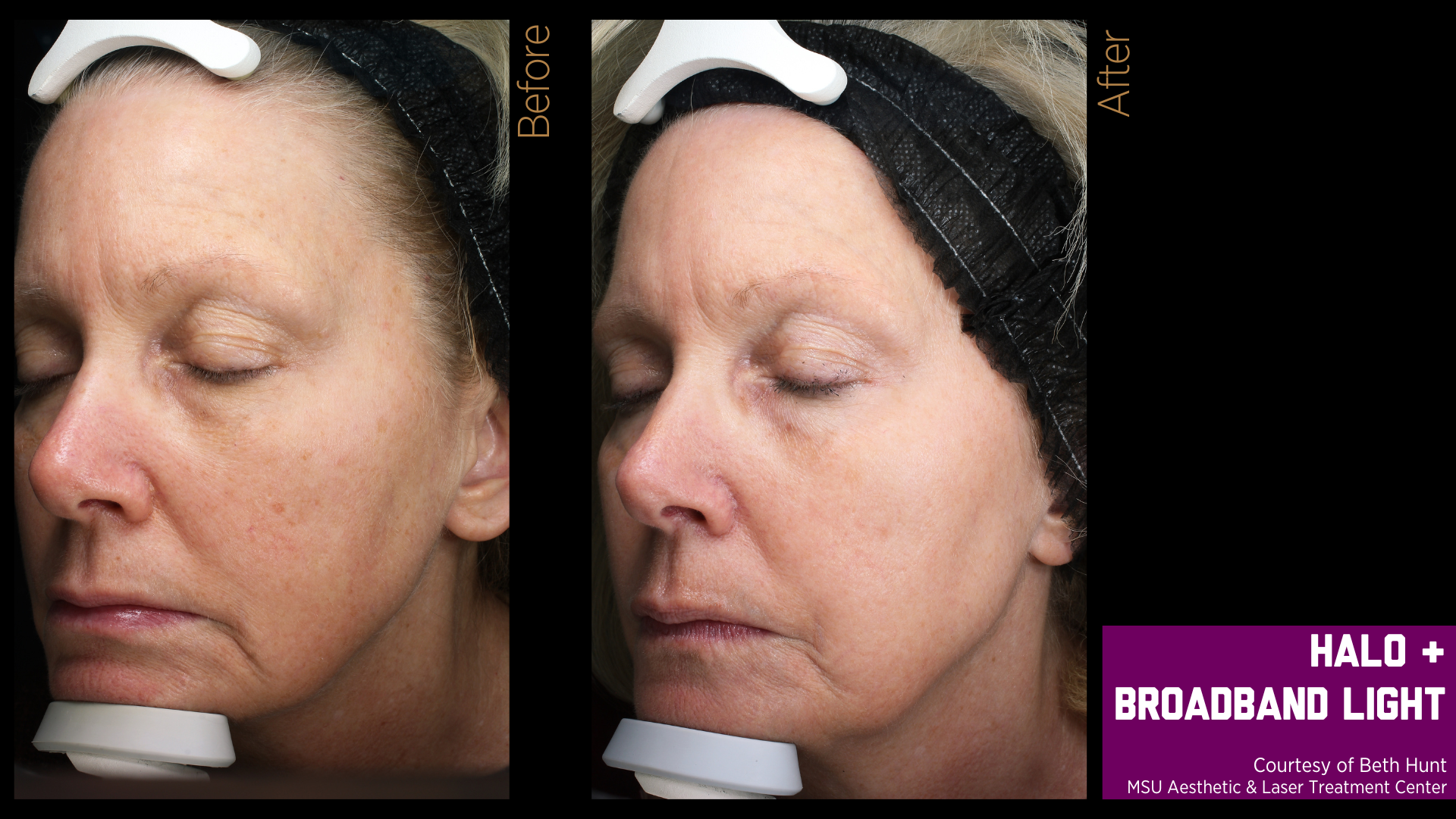 before and after treatment photos