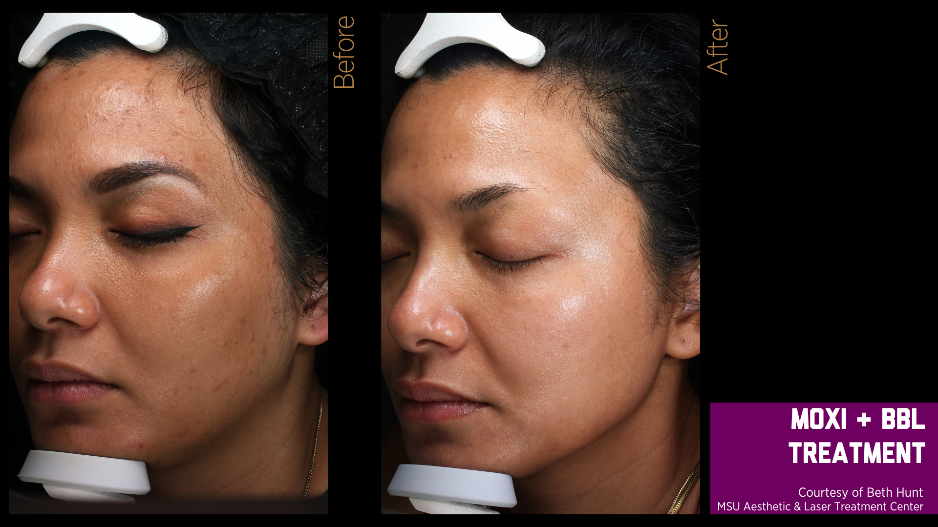 before and after treatment photos